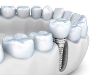 protect your smile after tooth loss Katy Texas