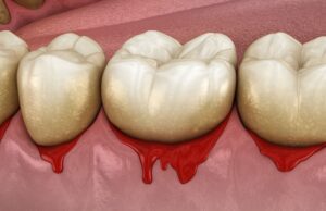 treat gum disease with urgent dental care