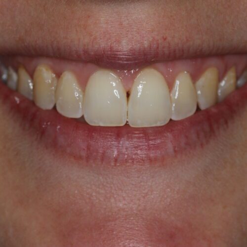 After cosmetic dentistry in Katy, TX