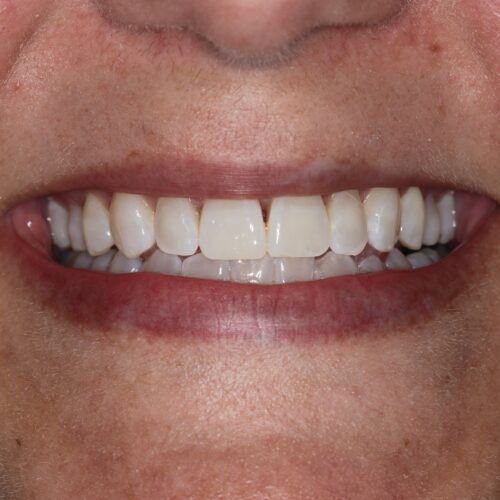 After cosmetic dentistry in Katy, TX