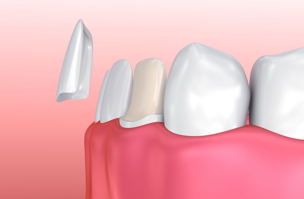 Porcelain Veneers Boost Oral Health